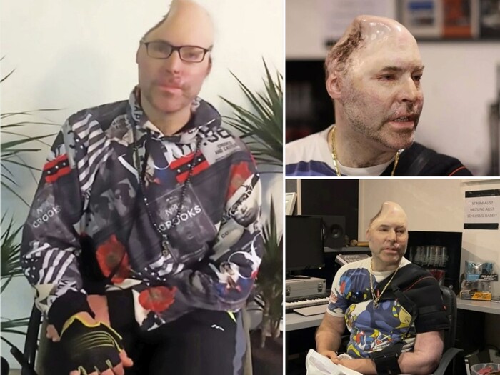 Немецкому рэперу, Dr Knarf (Никогда Бреннер), пришлось пережить серьёзную травму в результате взрыва в его домашней лаборатории