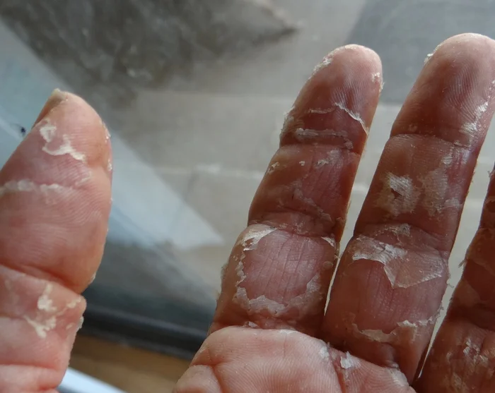 Seasonal Shedding or Disease? Exfoliative Keratolysis - My, The medicine, Disease, Disease history, Body check, Longpost, Doctors, Problem skin, Leather, Dermatology, Kvd, Treatment, Genetic diseases