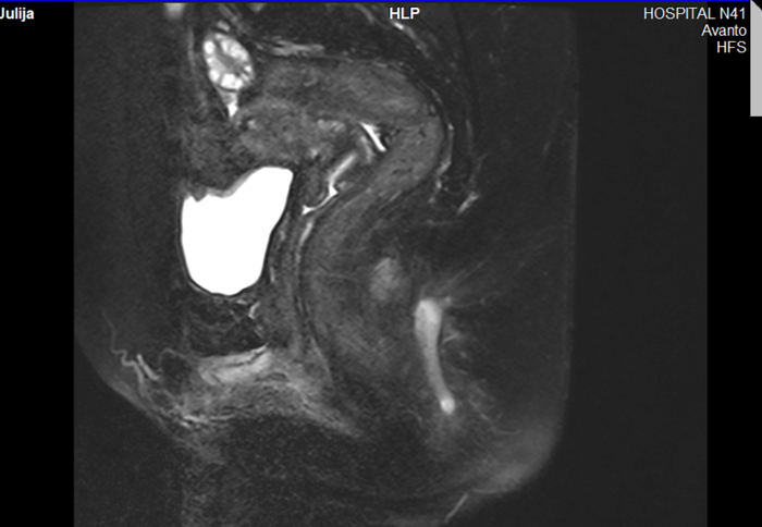 А тут видно, что внешнюю часть гноя таки при операции на парапроктите убрали