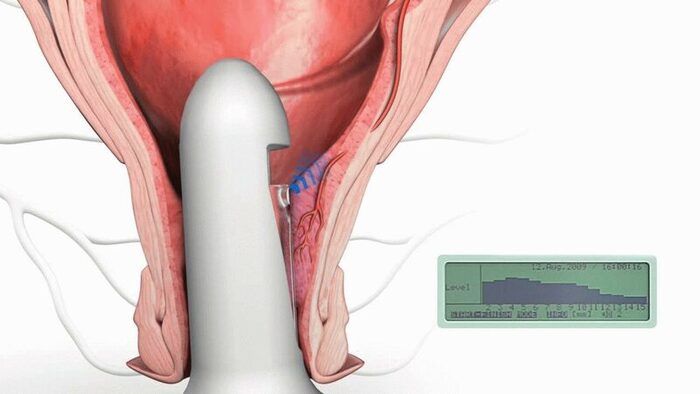 Вот он сам захватывает и прошивает узлы.