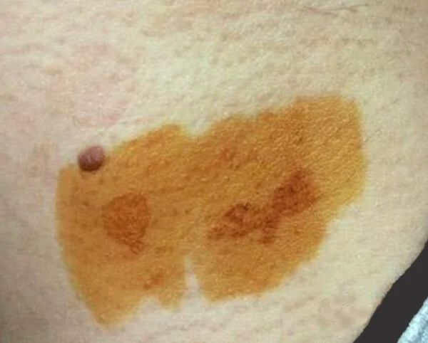 Fungal Spots - Versicolor Lichen - My, Problem skin, Dermatology, Fungus, The medicine, Medications, Stains, Longpost