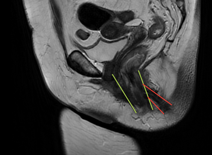 Желтое - анальный канал, красное - свищ