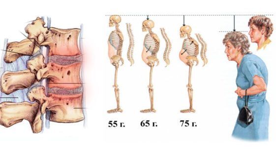 Соприкосновение рёбер с тазом