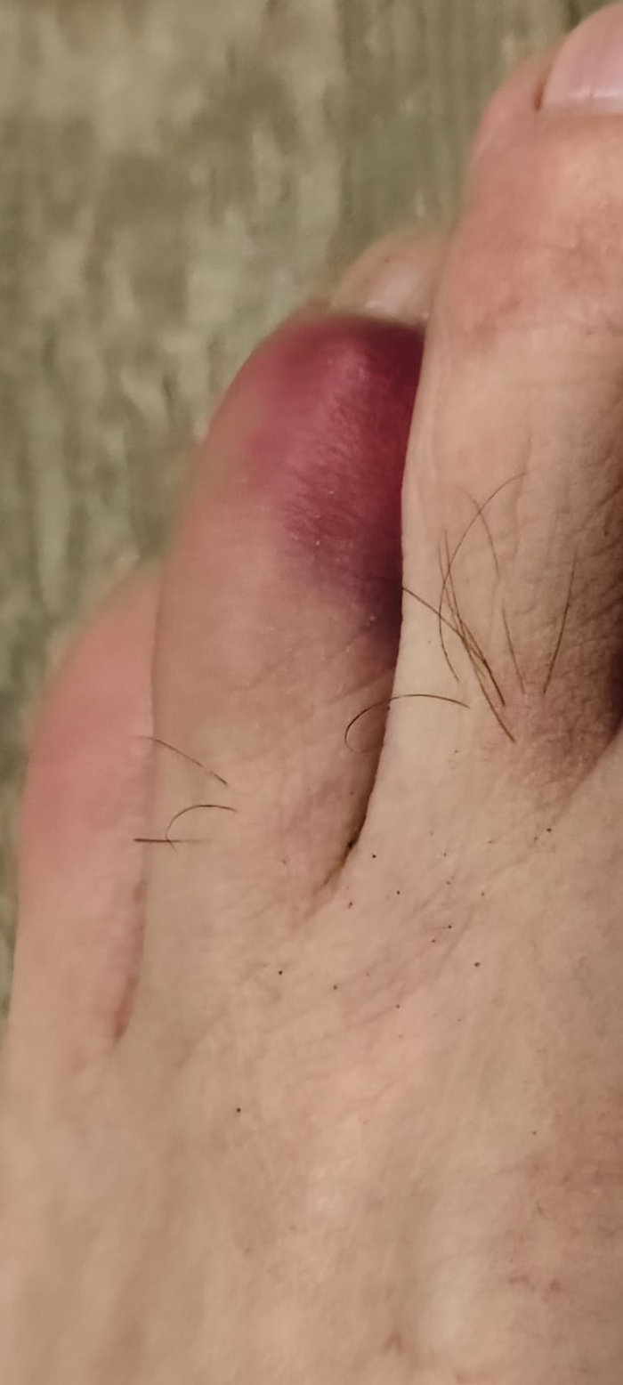 Обычно мизинце. Но тут безымянный пострадал...