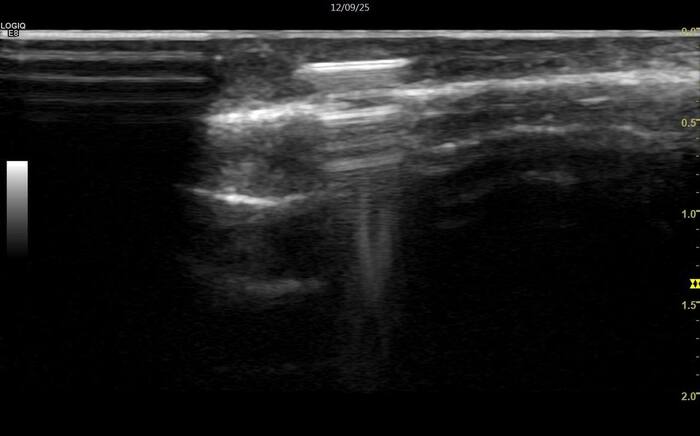 Вот так может выглядеть стекло при УЗ-исследовании - яркая тонкая полоса с усилением сигнала.