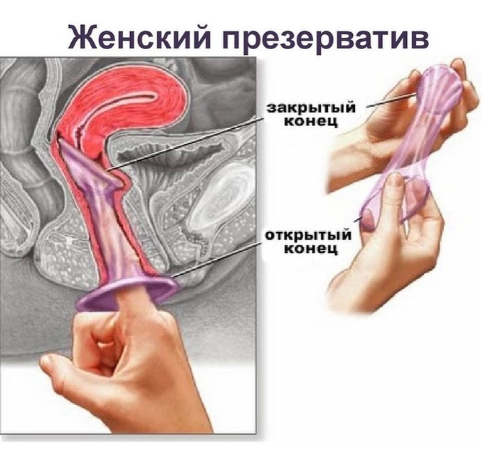 установка женского презерватива