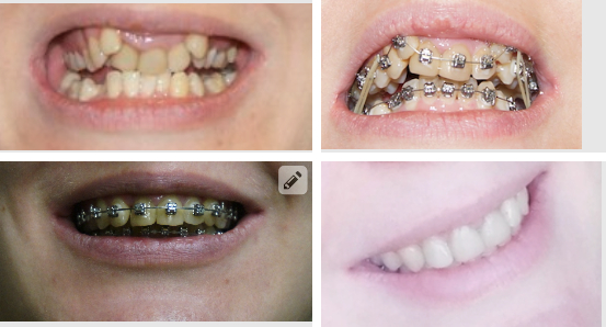 1 до брекетов 2-3 в процесс 4- 1й день после снятия