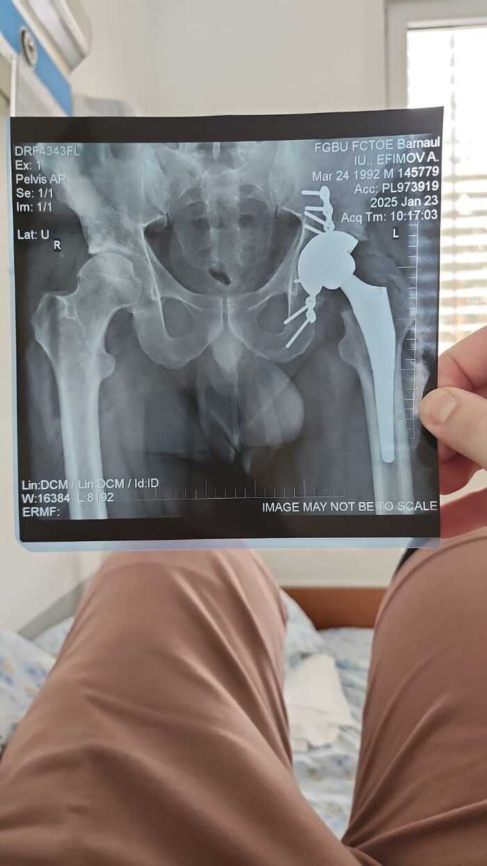 Перелом вертлужной впадины( продолжение 4.....финалочка)