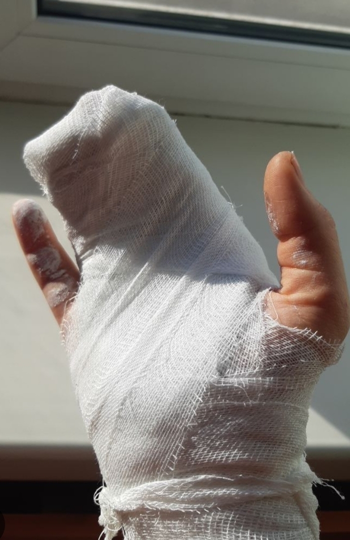 Сломал палец