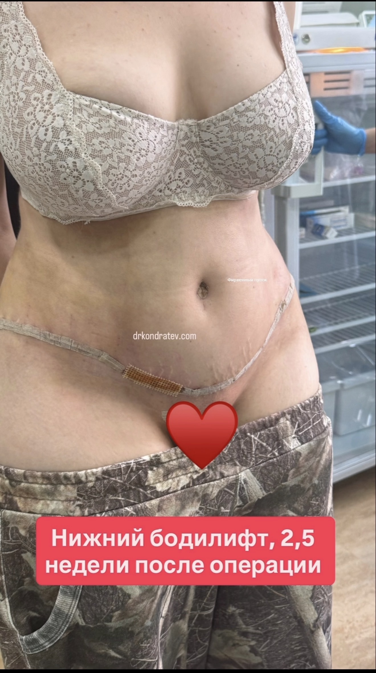 Her hourglass waist is unbreakable... - My, Childbirth, Body, Operation, Video, Vertical video, Short videos, Longpost, 18+, NSFW