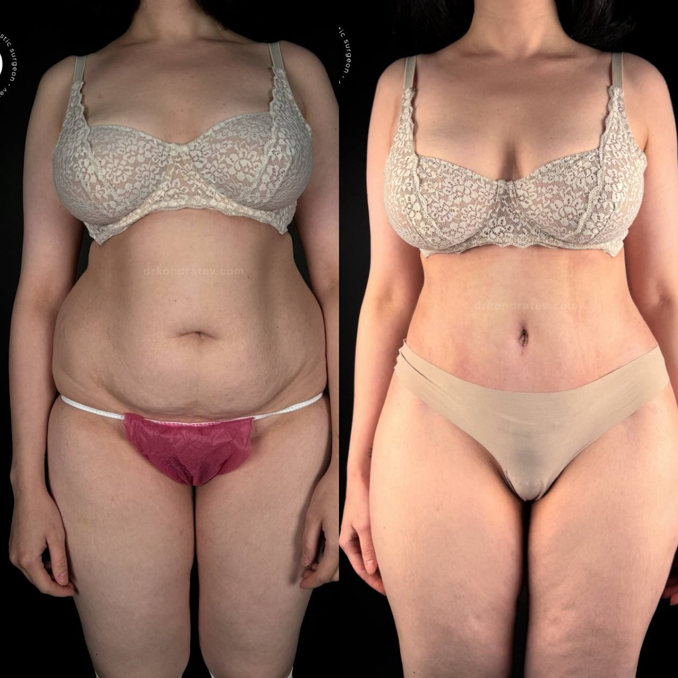 Her hourglass waist is unbreakable... - My, Childbirth, Body, Operation, Video, Vertical video, Short videos, Longpost, 18+, NSFW