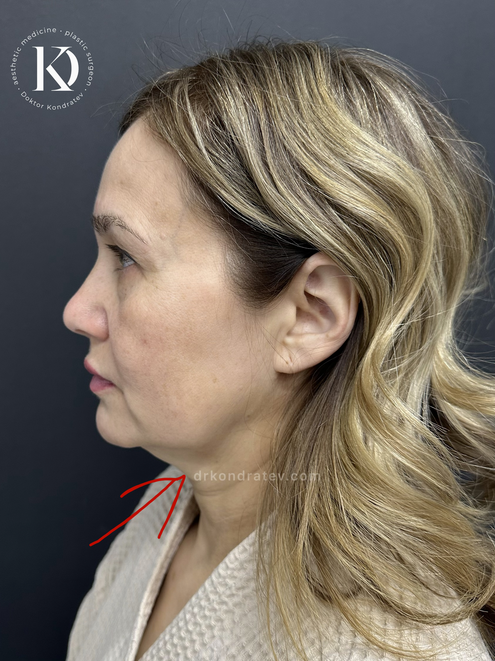 How to restore your original face without signs of overtightening? - My, Face, Facelift, Blepharoplasty, Video, Vertical video, Short videos, Longpost
