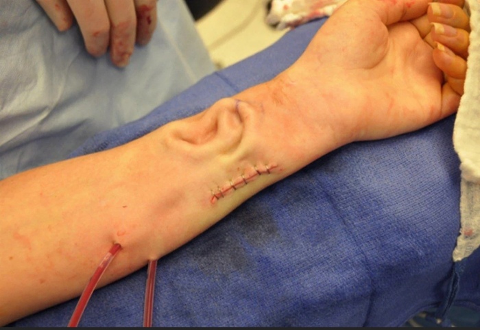 Через пару месяцев его пересадят на нужное место