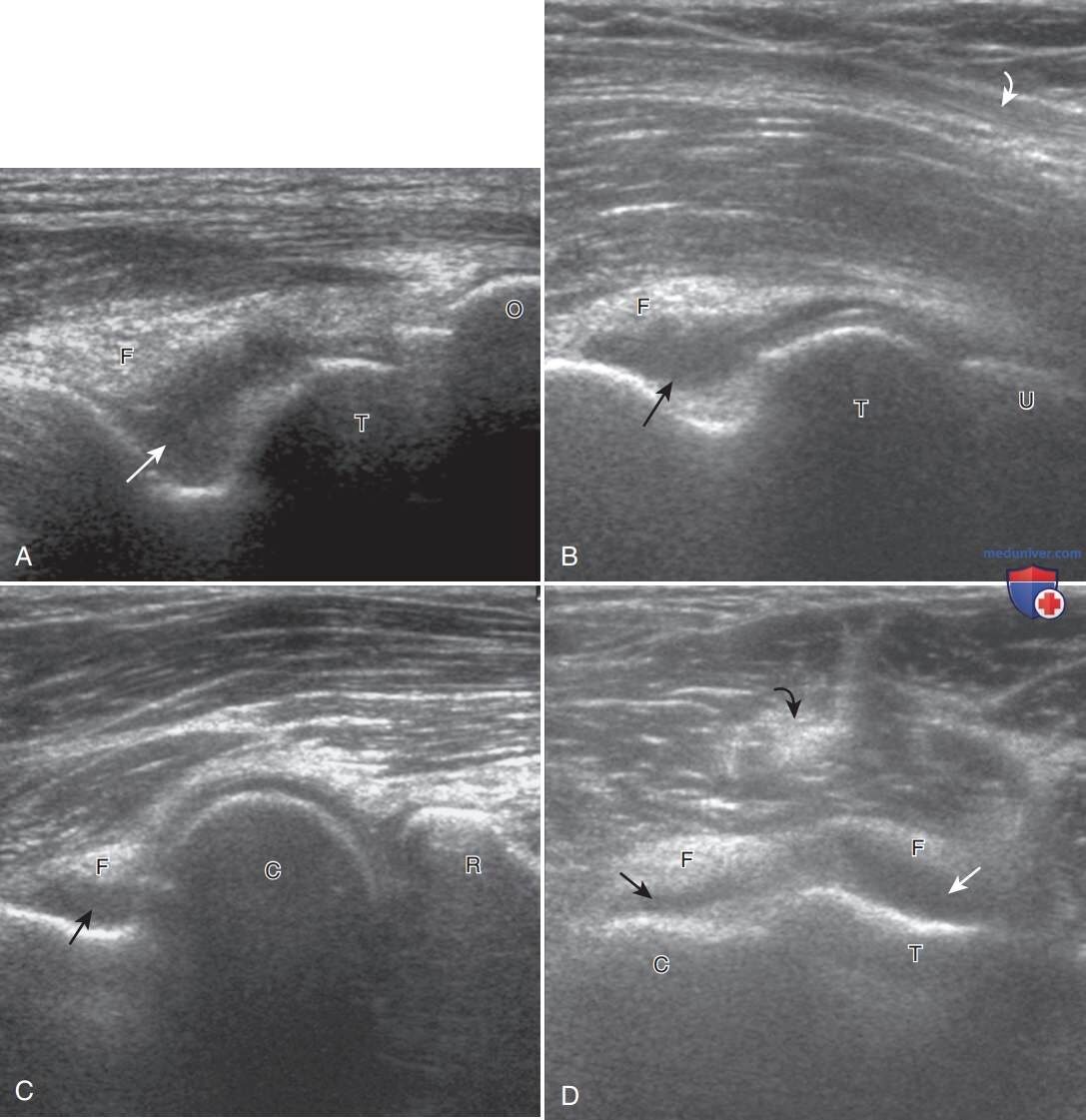 Elbow Pain. Part II. Inflammatory Diseases - My, Health, The medicine, Rheumatology, Rheumatologist, Rheumatoid arthritis, Bechterew's disease, Ankylosing spondylitis, Psoriatic arthritis, Gout, Infection, Disease, Longpost
