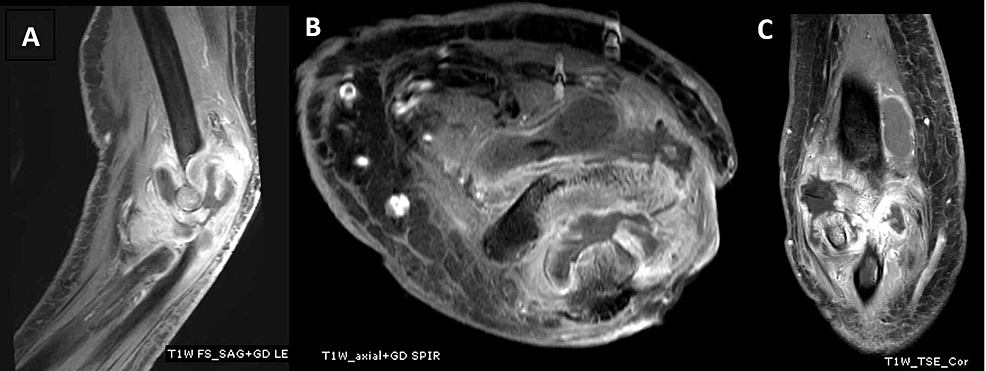 Elbow Pain. Part II. Inflammatory Diseases - My, Health, The medicine, Rheumatology, Rheumatologist, Rheumatoid arthritis, Bechterew's disease, Ankylosing spondylitis, Psoriatic arthritis, Gout, Infection, Disease, Longpost