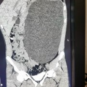 Почка с пятилитровую бутылку выросла у подростка в Новосибирске – ему спас жизнь осмотр перед трудоустройством