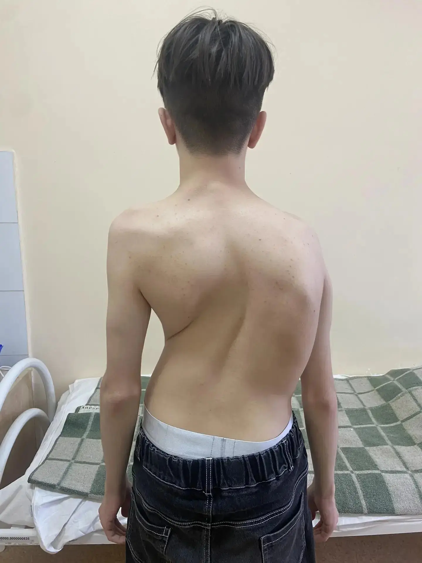 Samara doctors performed a complex operation on a teenager during a missile threat. - My, Operation, Negative, Scoliosis, The medicine, Surgery, Treatment