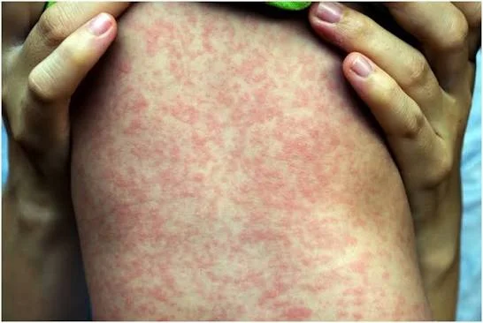 Reply to the post No, that's nonsense - Series Tyoma explains about medicine, Humor, Measles, Anti-vaccines, A wave of posts, Telegram (link), Screenshot, Reply to post, Longpost