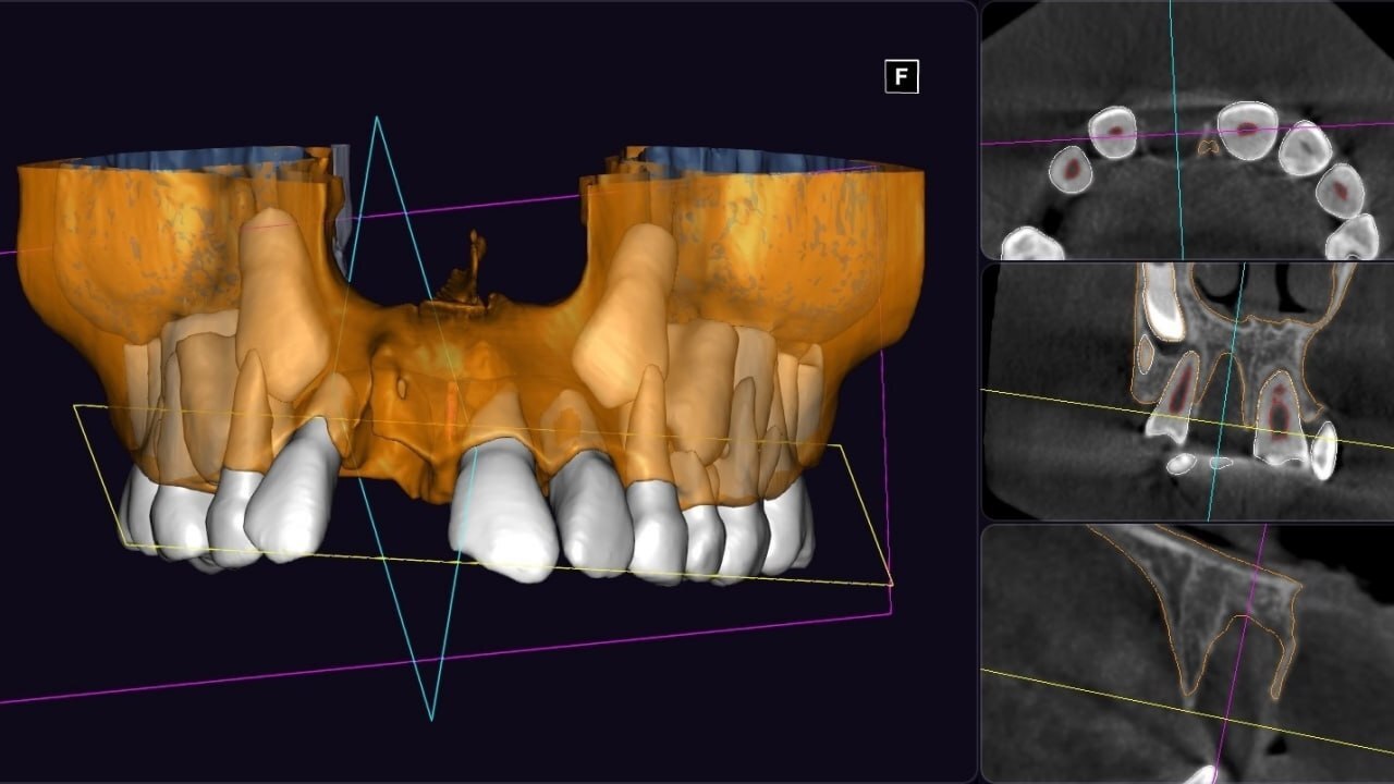 An 8-year-old female patient was referred by a colleague from St. Petersburg. - Dentistry, Teeth, Doctors, Health