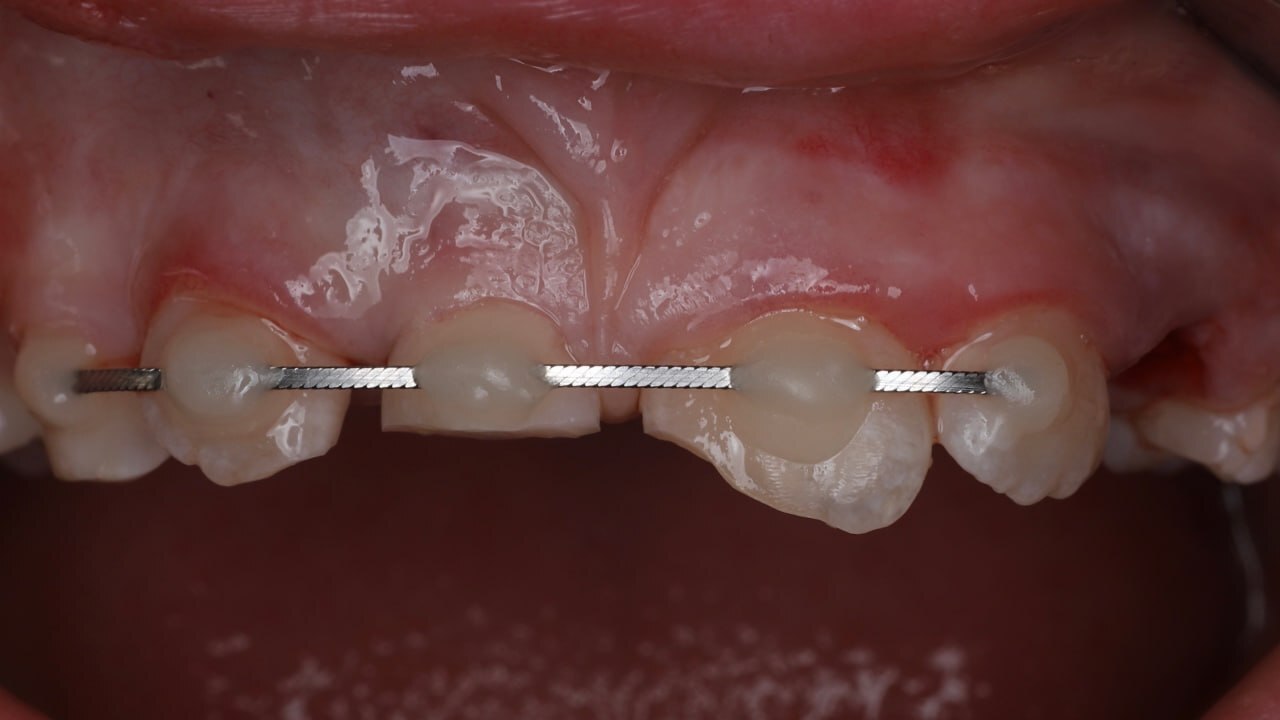 An 8-year-old female patient was referred by a colleague from St. Petersburg. - Dentistry, Teeth, Doctors, Health