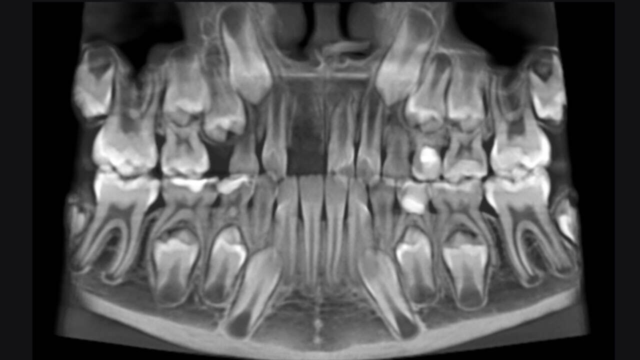 An 8-year-old female patient was referred by a colleague from St. Petersburg. - Dentistry, Teeth, Doctors, Health