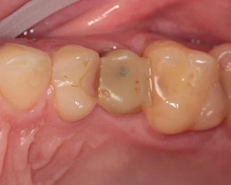 The Saga of Dentistry. Chapter 136. Why is it better to extract a tooth with thin root walls than to restore it with a crown? - Series The saga of dentistry, My, Dentistry, The medicine, Health, Doctors, Teeth, Dentist, Extraction of teeth, Crown, The patients, Medics, Surgery, Work, Longpost