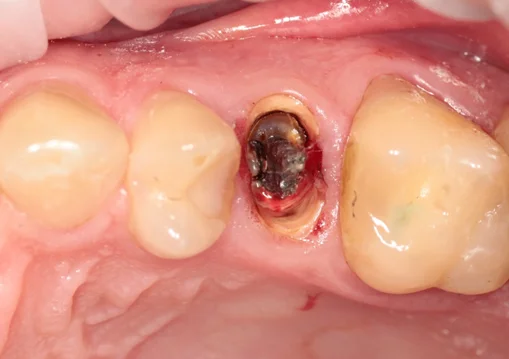 The Saga of Dentistry. Chapter 136. Why is it better to extract a tooth with thin root walls than to restore it with a crown? - Series The saga of dentistry, My, Dentistry, The medicine, Health, Doctors, Teeth, Dentist, Extraction of teeth, Crown, The patients, Medics, Surgery, Work, Longpost